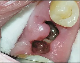 dry socket yellow bone