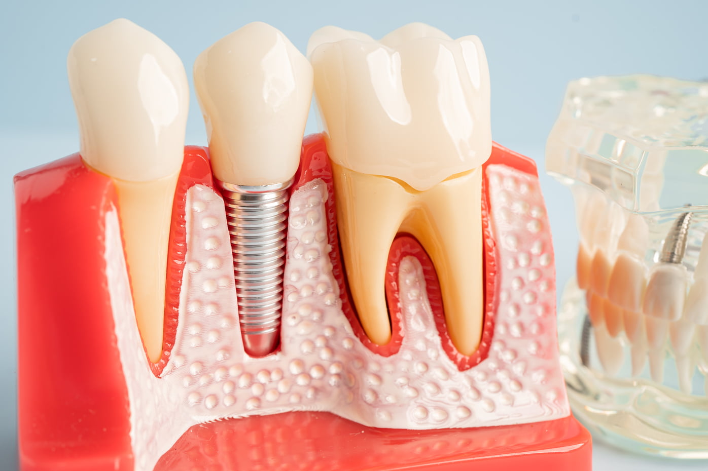 The Difference Between Dental Bridge And Implants 1 Dental implant artificial tooth roots into jaw r 2024 07 05 05 01 26 utc 1