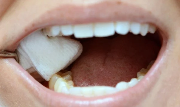 Dry Socket Vs Normal Socket After A Tooth Extraction