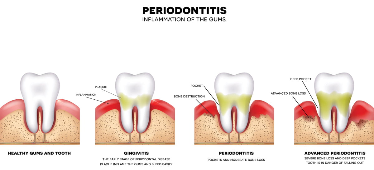 Common Questions About Gum Disease 1 Recognizing the 4 stages of gum disease orig