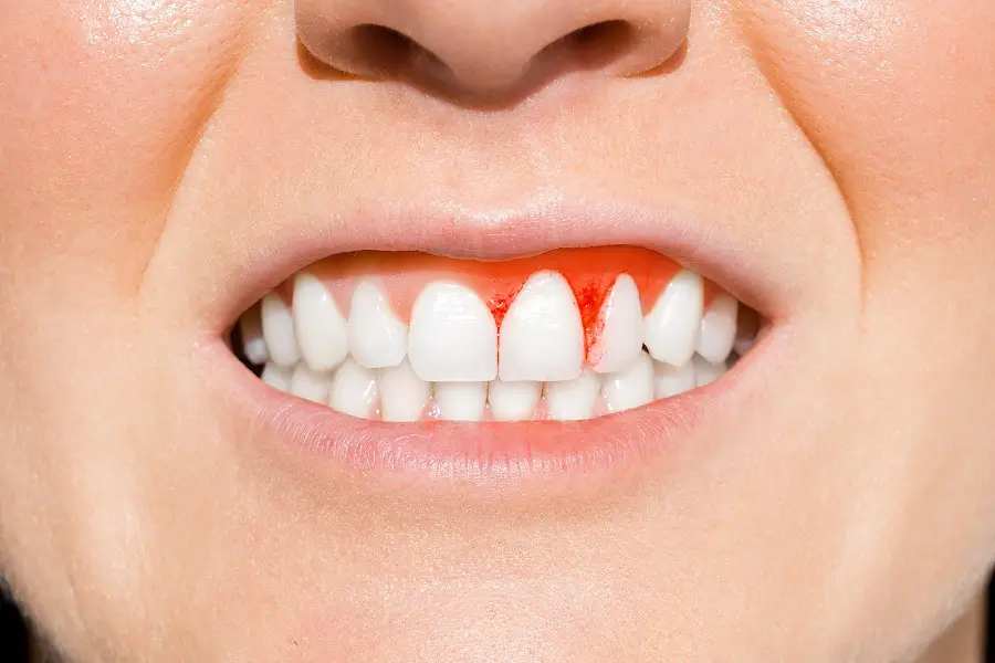 Apa Perlu Dilakukan Kalau Tiba-Tiba Gigi Longgar 1 Bigstock woman with bleeding gums peri 403917095 tzzq2wr