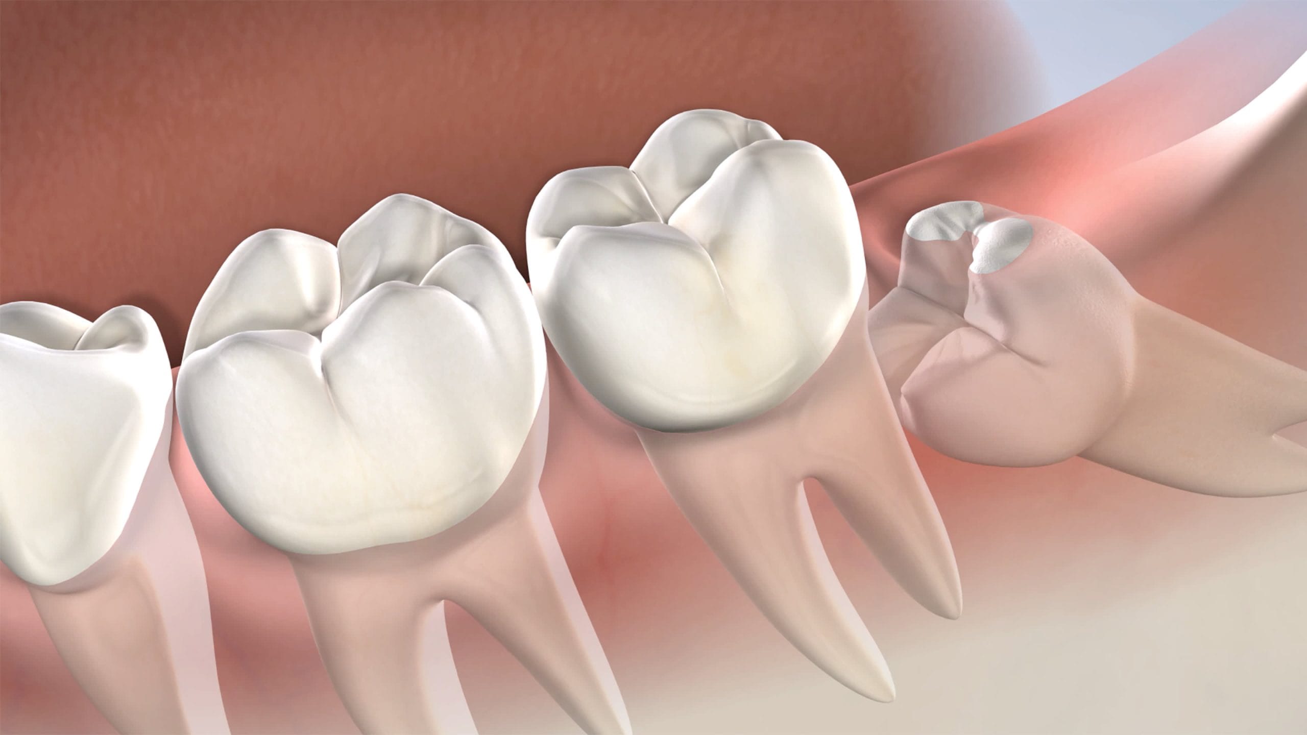 Gusi Belakang Bengkak? Inilah Penyakit Yang Boleh Menyebabkannya 1 Instruction video thumb wisdom tooth scaled