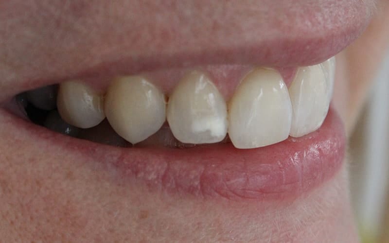 Apakah Tompok Putih Pada Gigi Ini? 2 White spots on teeth
