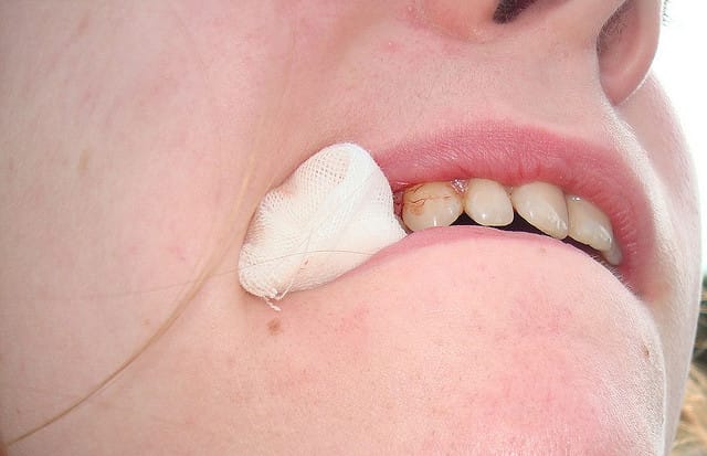 Adakah Lapisan Putih Di Gusi Selepas Cabut Gigi Normal? 1 Tooth extraction gauge