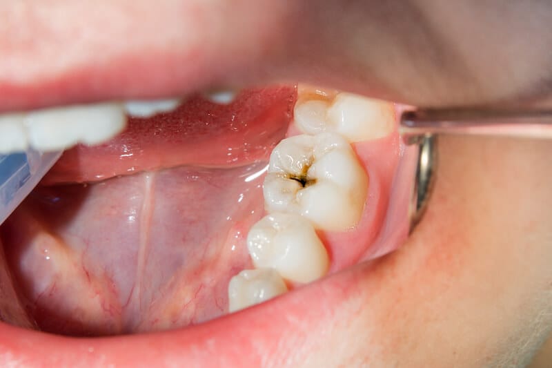 Penyebab Gigi Sensitif Dan Cara Mengatasinya 2 621f96460c991499dfc0f162 cavity2