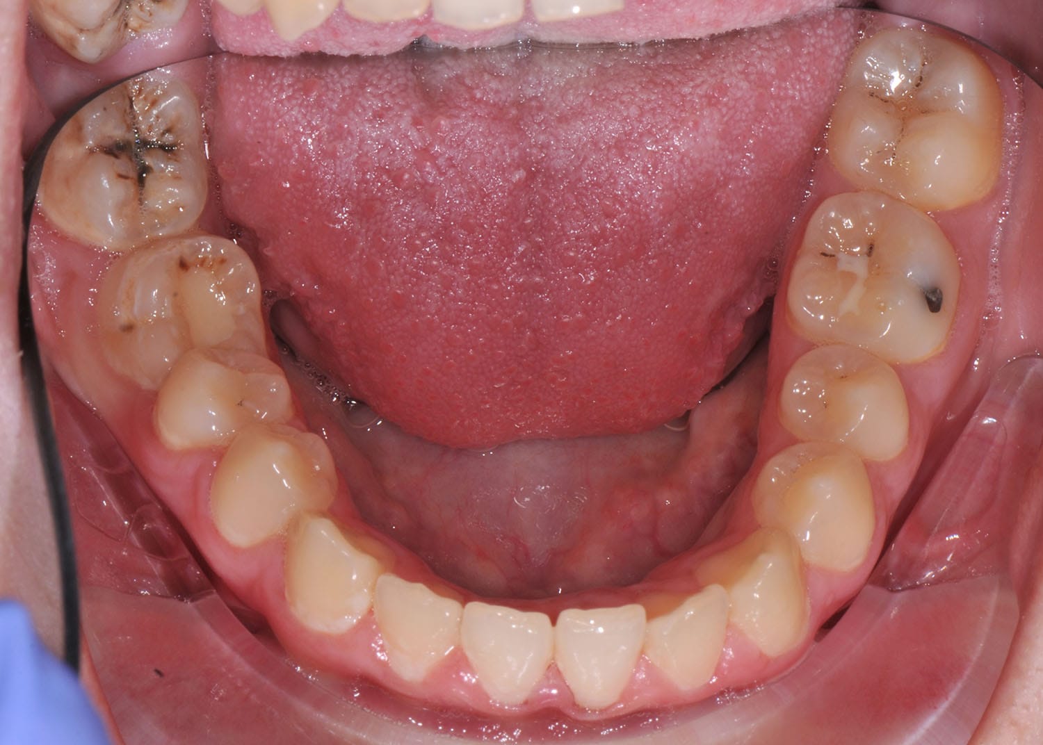 Bintik Hitam: Cara Hilangkan Plak Hitam Pada Gigi 2 63b7cb9a196ba17456d02495 lower teeth black hole cavities