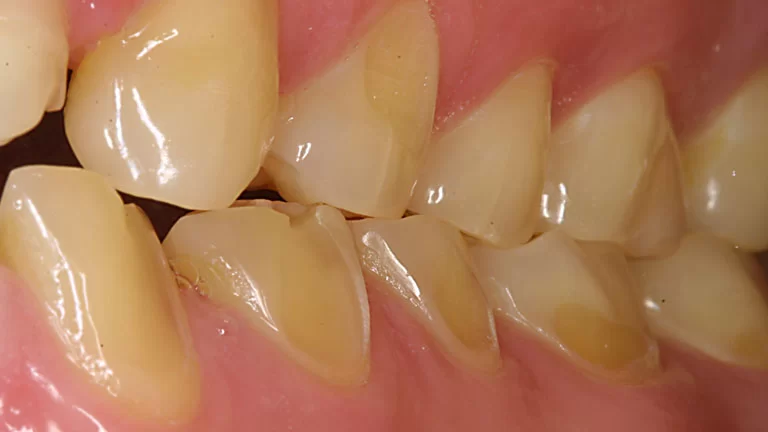 Penyebab Gigi Sensitif Dan Cara Mengatasinya 1 Conditions enamel erosion