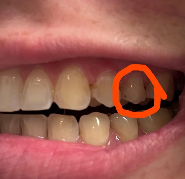Bintik Hitam: Cara Hilangkan Plak Hitam Pada Gigi 1 What is this black spot on my premolar v0