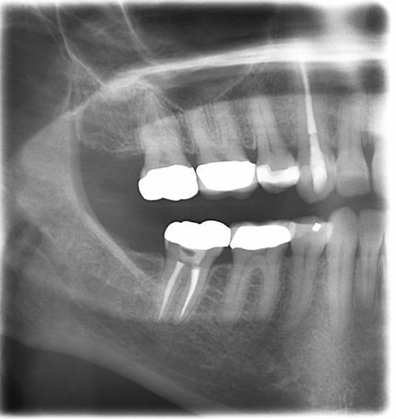 An example of a bitewing x ray