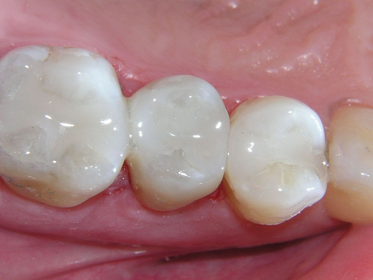 Ceramic dental fillings 1