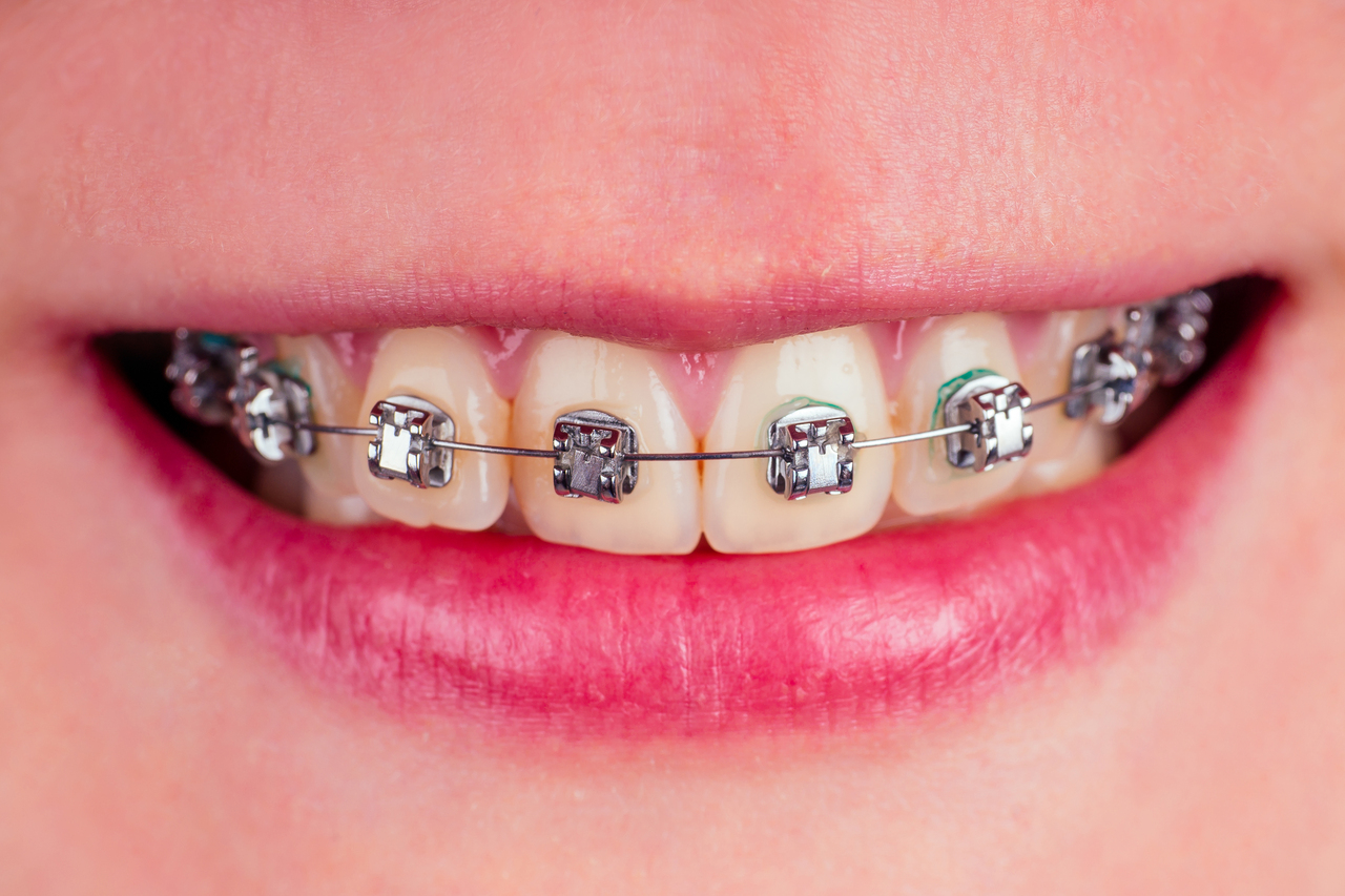 Metal braces