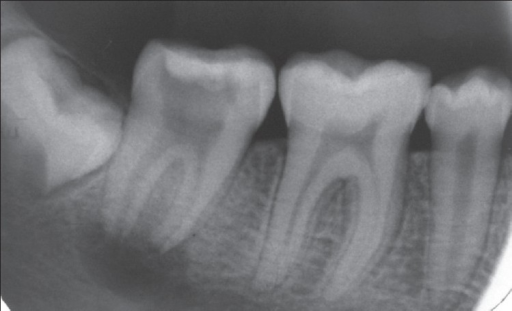 Periapical x ray 1