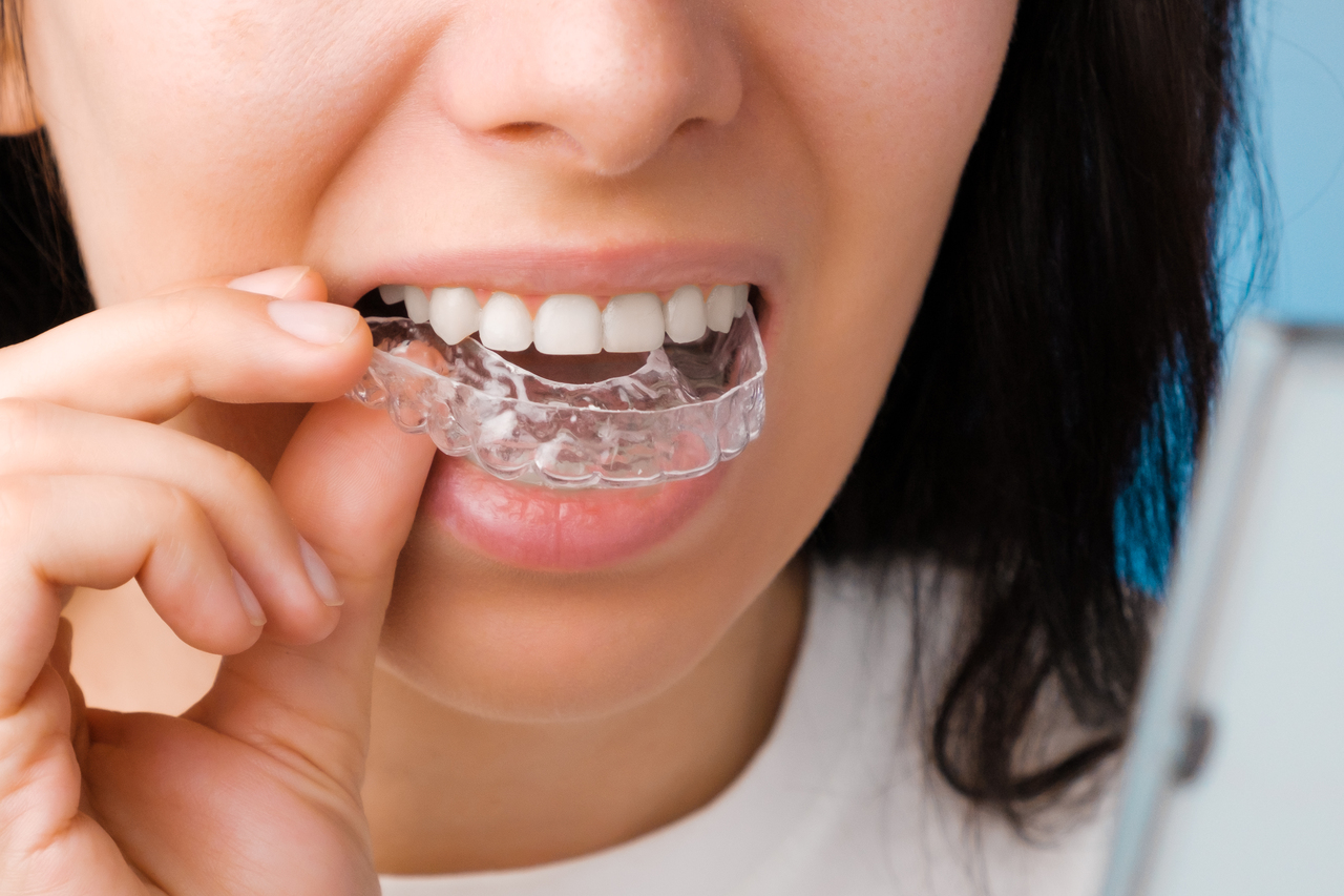 Lady with invisalign clear aligners