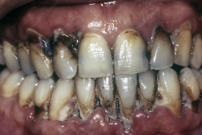 Teeth with tartar