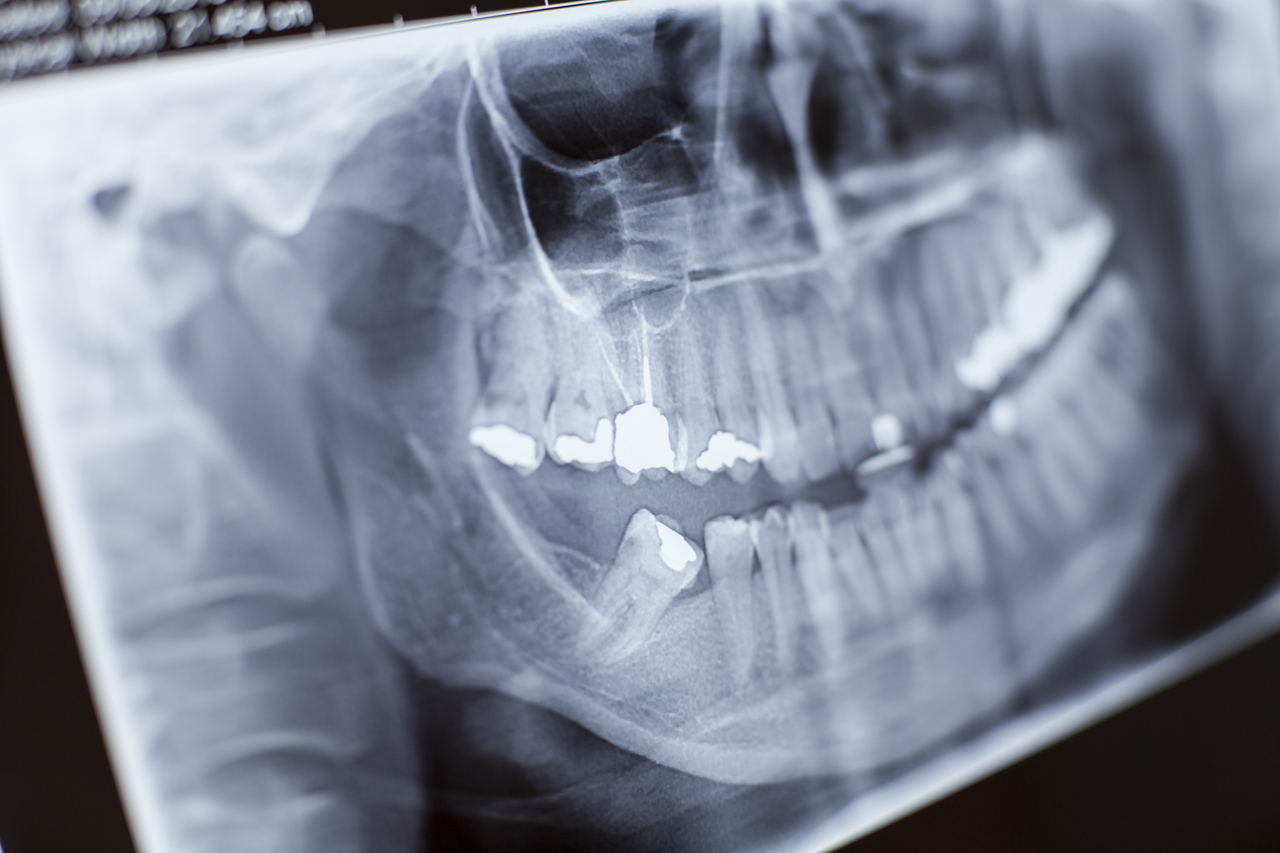 example of a close up dental xray