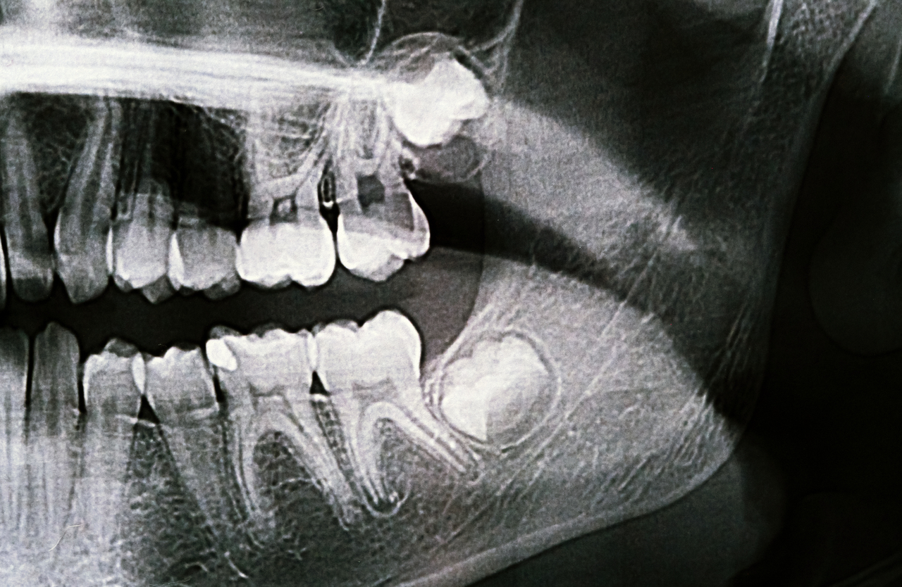xray of wisdom tooth