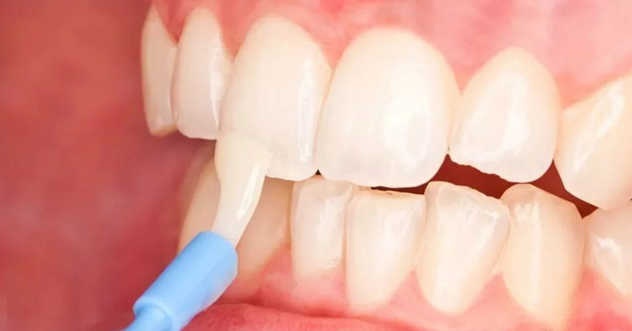 Fluoride varnish