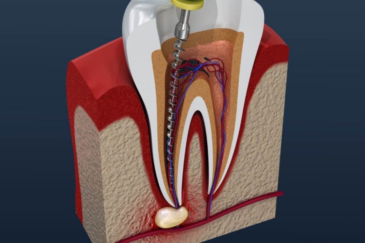 Illustration of a root canal 768x512 1