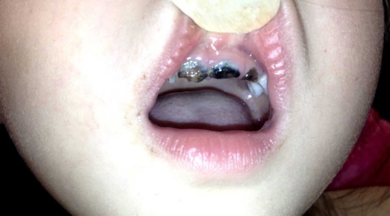 karies gigi anak - child caries