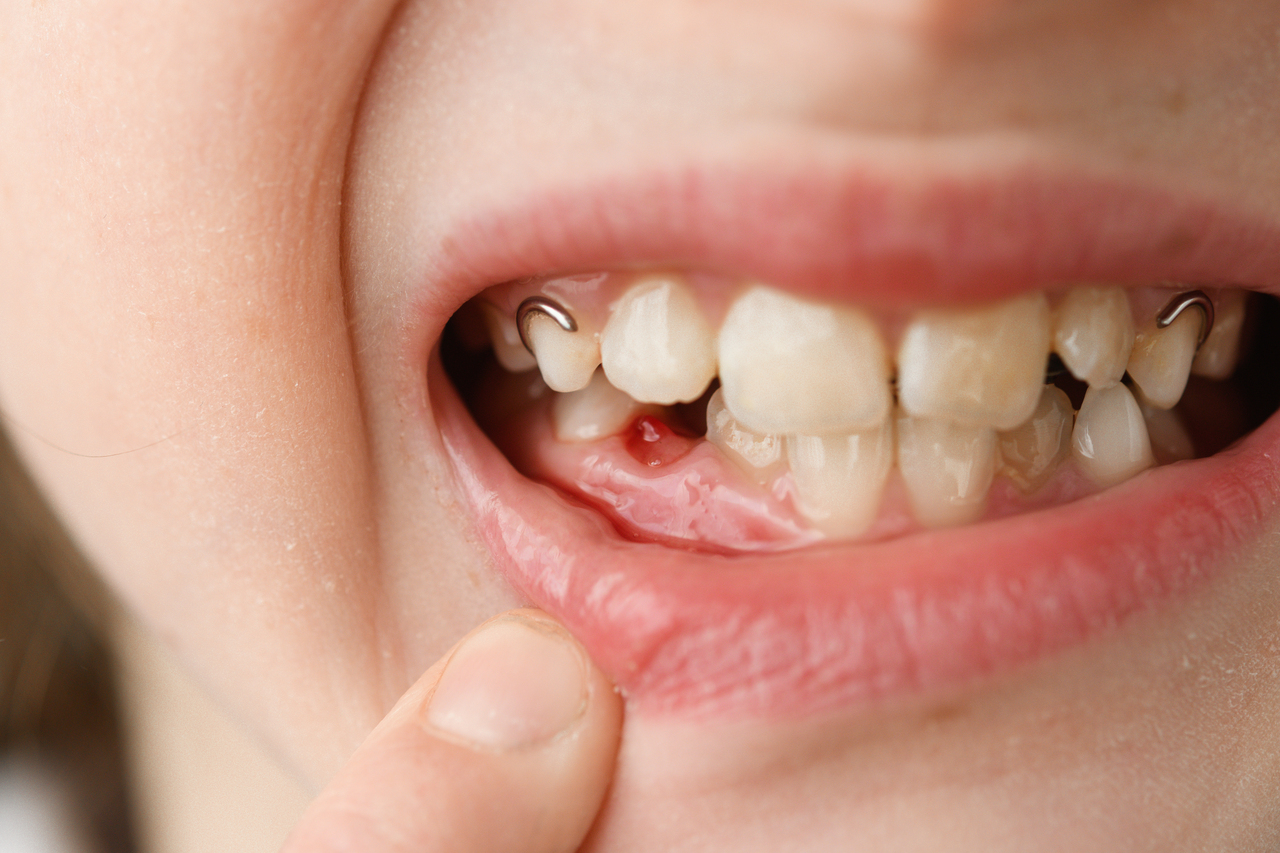 gap in teeth after tooth extraction cabut gigi