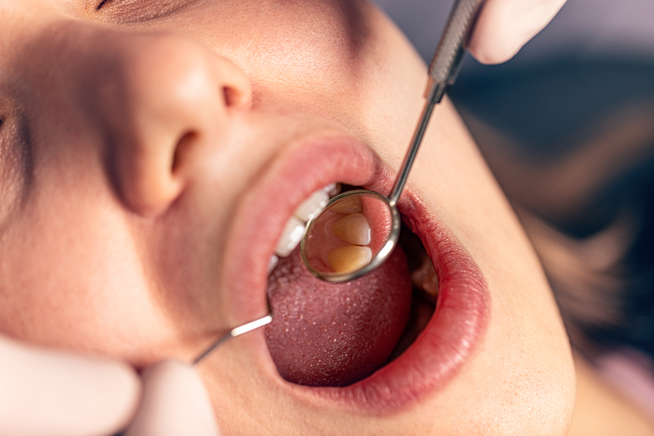 dental mirror in open mouth during dental check up