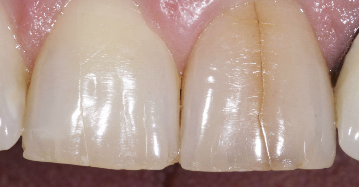 Crack in tooth