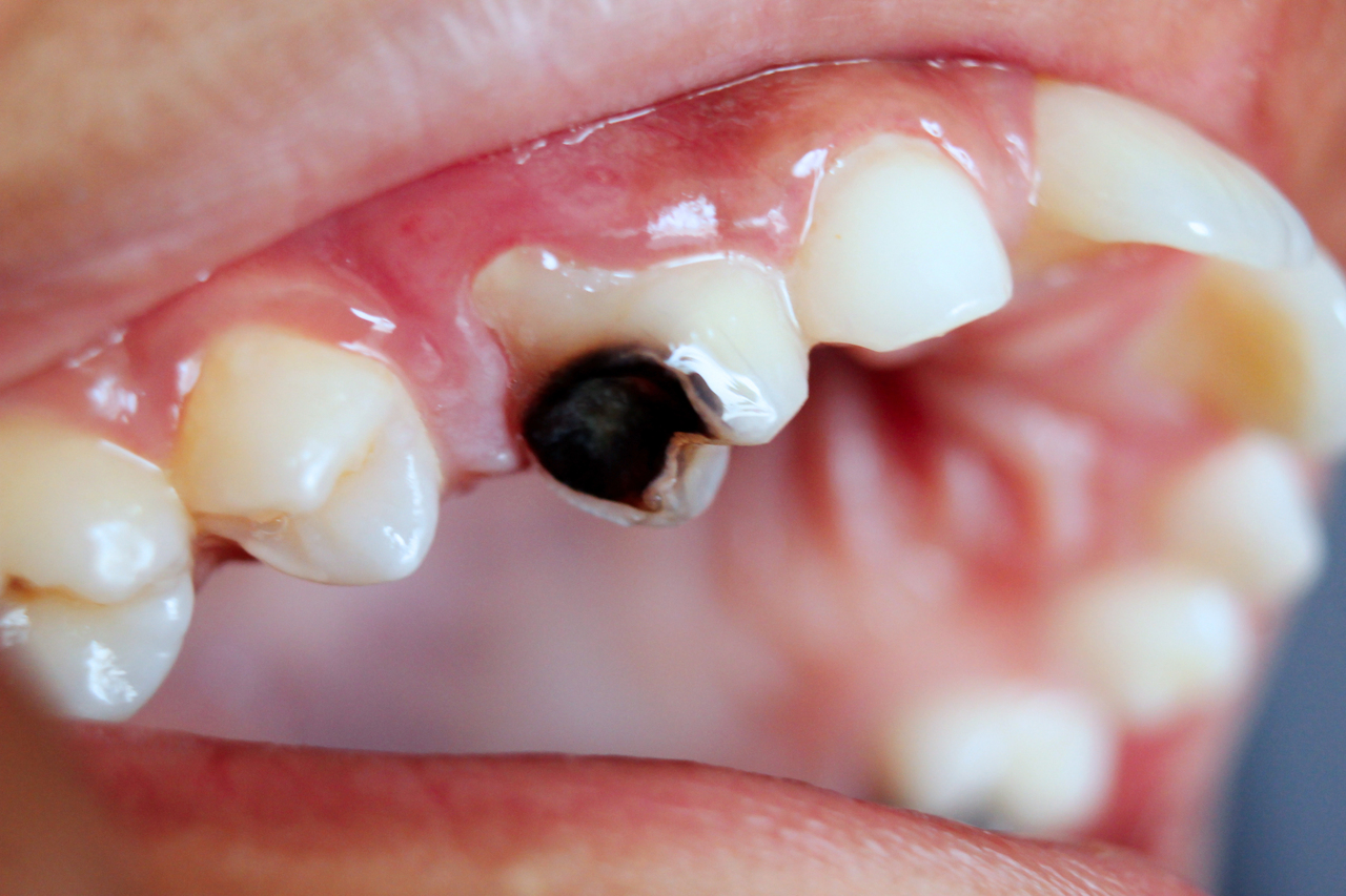 Dental cavity