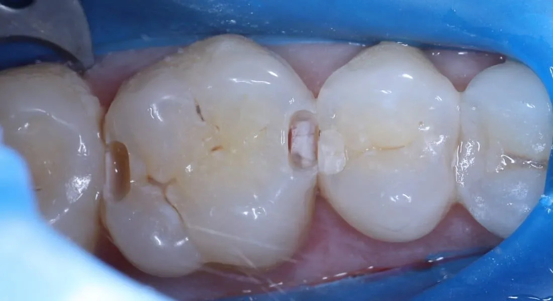 Interproximal caries