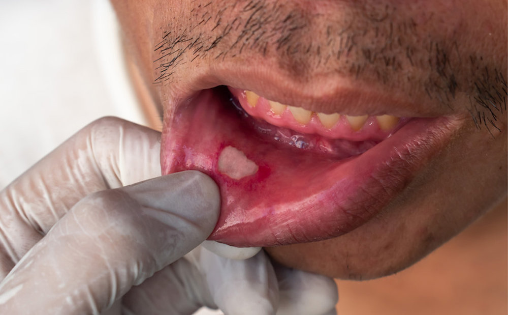 Ulcer oral lesions lesi mulut