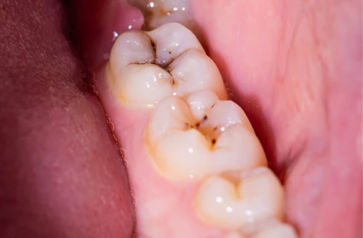 karies gigi - dental caries
